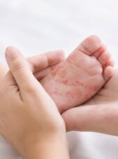 Volwassen vrouwen handen houden het voetje van een baby met vlekken van de mazelen er op vast.